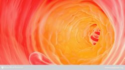 Chcholesterol plaque in artery