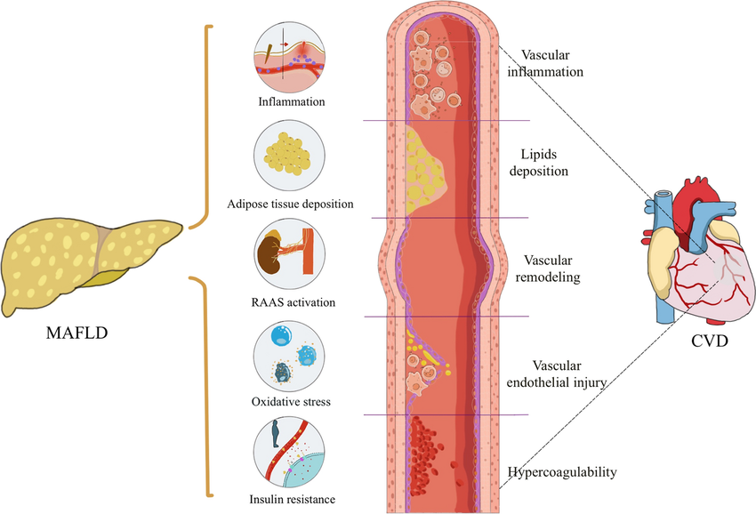 Zhou, Xiao-Dong et al. (2022). Metabolic dysfunction-associated fatty liver disease and implications for cardiovascular risk and disease prevention. Cardiovascular Diabetology. 21. 10.1186/s12933-022-01697-0.